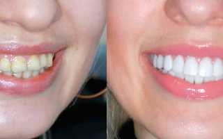 Как выглядит композитный винир: фото зубов до и после