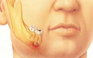Периостотомия — эффективная зубосохраняющая стоматологическая операция