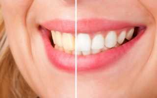Потемнение зуба – несомненный повод для визита к стоматологу