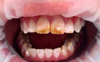 Флюороз зубов: фото стадий, вредные пасты и местность