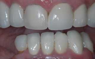 Популярные виды протезов на жевательные зубы и их особенности