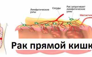 Рак прямой кишки: лечение и профилактика