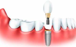Сколько стоит установить имплантат зуба: детальный обзор всех составляющих