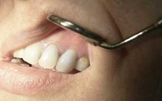 Киста зуба: все симптомы заболевания