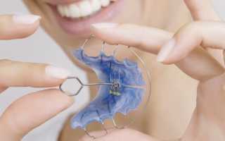 Пластины для выравнивания зубов – подробный обзор