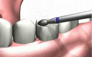Особенности методик препарирования зубов и основные этапы