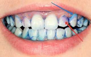 Как подобрать качественный и недорогой индикатор зубного налета
