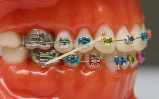 Ускорить процесс выравнивания зубов помогут резинки для брекетов