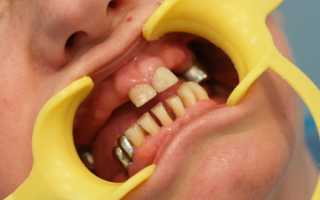 Сложное протезирование зубов или комплексный подход к восстановлению
