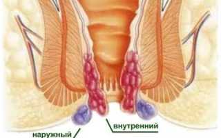 Лечение геморроя при грудном вскармливании: советы по профилактике