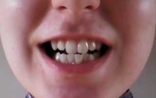 Клиника и основные способы коррекции сужения челюстей и зубных рядов