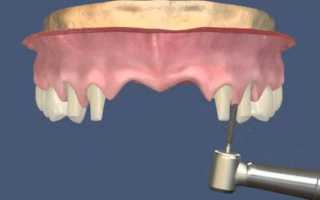 Правила выбора опорных зубов для съемных и несъемных протезов