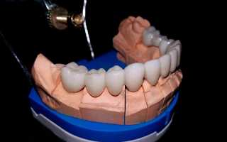 Что такое стоматологическая керамика, и как она используется при протезировании