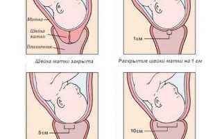 Внутренние швы после родов: виды, симптомы осложнений и уход