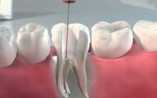 Пломбирование методом латеральной конденсации – идеальный подход к сохранению проблемного зуба