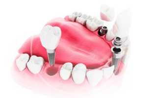 Современные методы имплантации нижних зубов