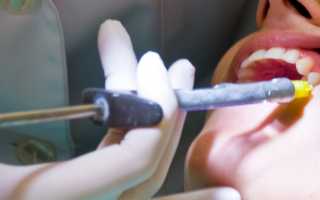 Как делается проводниковая анестезия в стоматологии