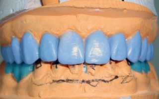 Что значит восковое моделирование зубов, и зачем оно нужно?