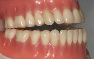 Немецкий подход к долговечному и эстетическому протезированию — зубы Ivoclar