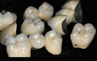 Методы восстановления всех видов искусственных коронок зубов