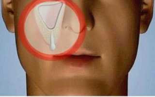Гайморит после имплантации зубов – ошибка специалиста или вина физиологии?