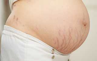 Применение масел для борьбы с растяжками при беременности