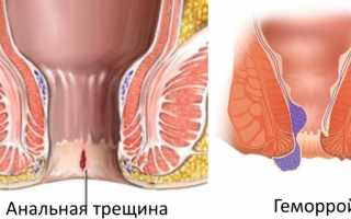 Анальные трещины прямой кишки при геморрое