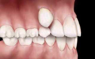 Персистентный зуб – это подарок судьбы или проблема?