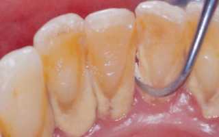 Почему появляется зубной налет и как можно его убрать