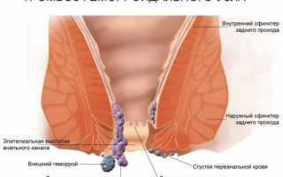 Тромбоз геморроидального узла: лечение и профилактика
