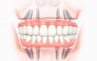 All-on-6 имплантация – инновационная методика для восстановления отсутствующих зубов