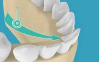 Чем опасно вестибулярное положение зубов и как исправляется дефект