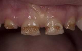 Особенности зубов Тернера – местной формы гипоплазии эмали