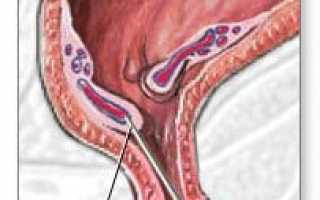 Операция склеротерапия геморроя: рекомендации и противопоказания