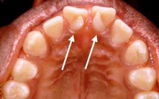 Что такое инвагинация зуба, чем она опасна, как ее лечить?