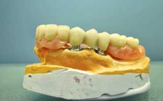 Телескопические зубные протезы как достойная альтернатива имплантации