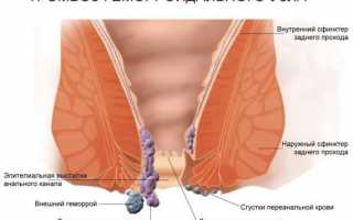 Что такое геморроидальные узлы и их тромбоз?