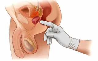 Пальцевое исследование прямой кишки при геморрое