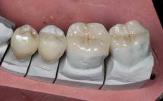 Все тонкости восстановления зубов полукоронками