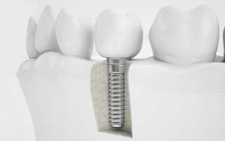 Почему специалисты отдают предпочтение титановым имплантам зубов?
