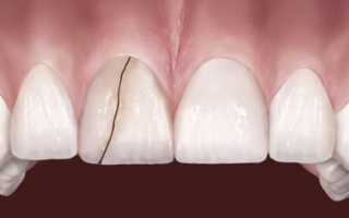 Что нужно делать, когда треснул зуб вертикально или горизонтально?