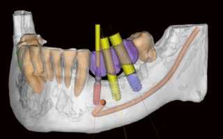 Технические возможности имплантации зубов 3d