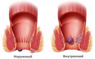 Лечение внутреннего геморроя у мужчин