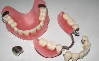 Как определить, какие зубные протезы лучше: съемные или несъемные