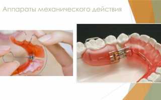 Эффективные ортодонтические аппараты механического действия