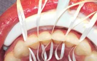 Процедура шинирования зубов: фото до и после