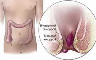 Профилактика и лечение геморроидальных шишек