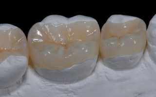 Микропротезы – идеальный выбор для восстановления эстетики и функциональности зубного ряда