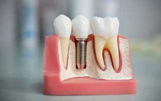 Имплантация зубов — как недорого и надежно восстановить эстетику и полноценные функции