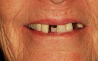 Особенности всех видов протезирования при отсутствии большого количества зубов